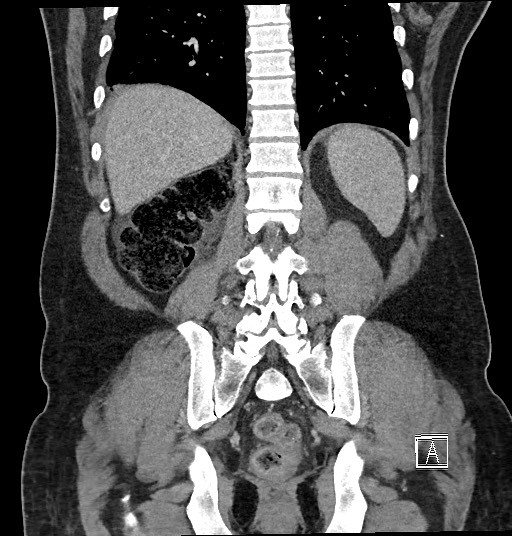 Closed loop obstruction - internal hernia into nephrectomy bed (Radiopaedia 59867-67320 B 106).jpg