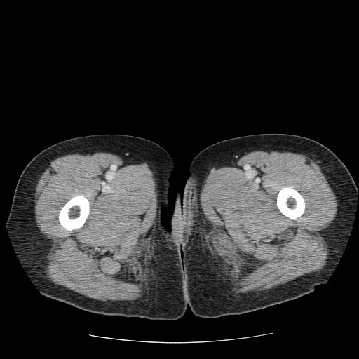File:Closed loop small bowel obstruction (Radiopaedia 65403-74451 Axial 92).jpg