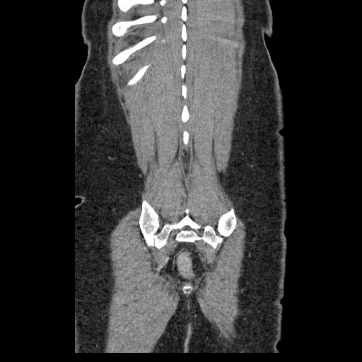 Closed loop small bowel obstruction (Radiopaedia 65403-74451 B 93).jpg