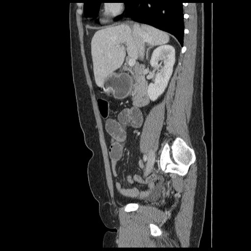 Closed loop small bowel obstruction (Radiopaedia 65403-74451 C 36).jpg