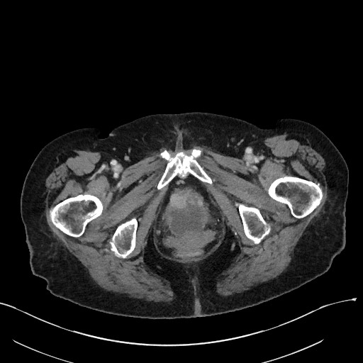 File:Closed loop small bowel obstruction - adhesions (Radiopaedia 59269-66611 Axial 116).jpg
