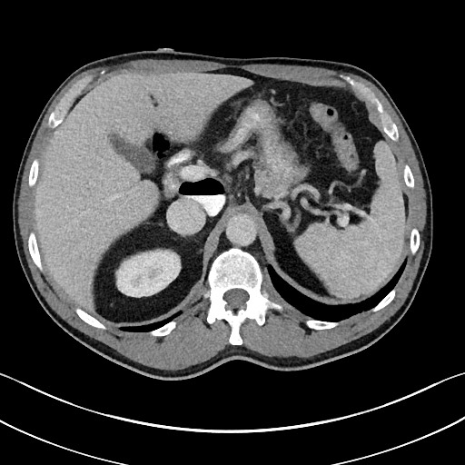 Closed loop small bowel obstruction - internal hernia (Radiopaedia 57806-64778 B 33).jpg