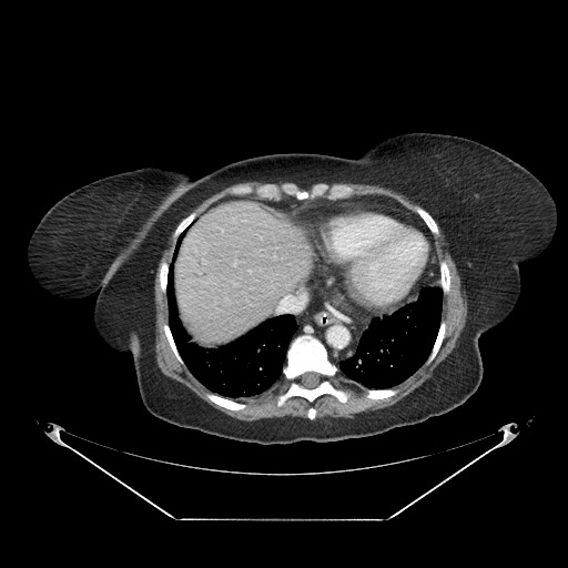 Closed loop small bowel obstruction - internal hernia (Radiopaedia 65402-74450 A 7).jpg
