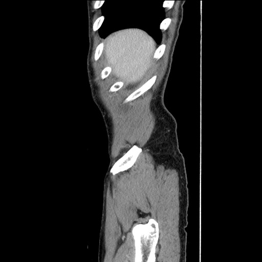 Closed loop small bowel obstruction - omental adhesion causing "internal hernia" (Radiopaedia 85129-100682 C 28).jpg