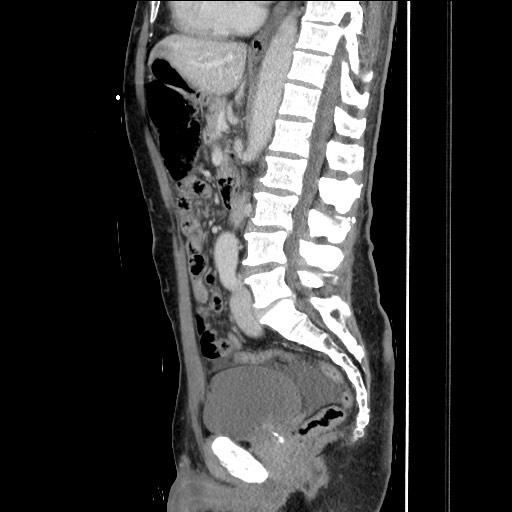 File:Closed loop small bowel obstruction - omental adhesion causing "internal hernia" (Radiopaedia 85129-100682 C 94).jpg