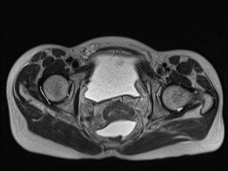Closed loop small bowel obstruction in pregnancy (MRI) (Radiopaedia 87637-104031 D 37).jpg