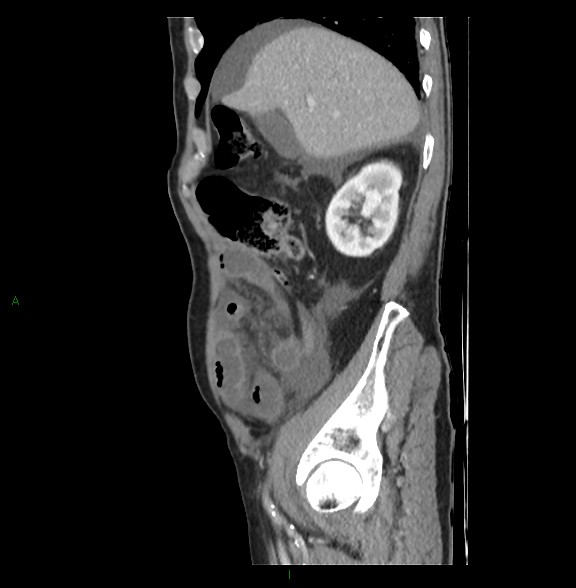 Closed loop small bowel obstruction with ischemia (Radiopaedia 84180-99456 C 25).jpg