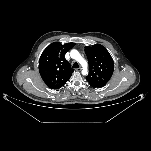 Coarctation of aorta (Radiopaedia 25384-25630 A 41).jpg