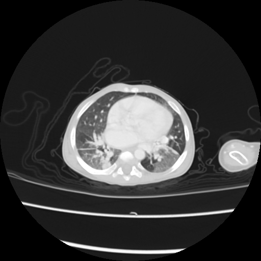 Coarctation of the aorta and patent ductus arteriosus (Radiopaedia 68033-77499 Axial lung window 33).jpg