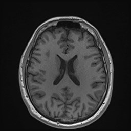 Cochlear incomplete partition type III associated with hypothalamic hamartoma (Radiopaedia 88756-105498 Axial T1 122).jpg