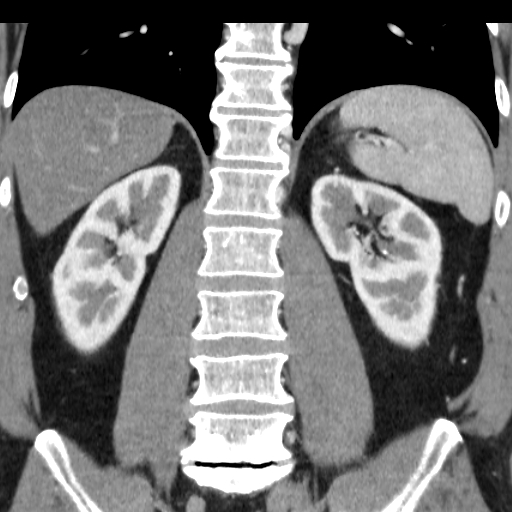 File:Collateral circulation following left renal vein thrombosis (Radiopaedia 17319-17013 renal cortical phase 7).jpg