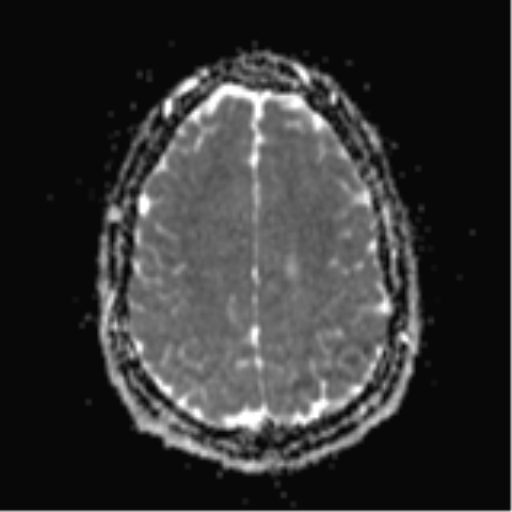 File:Colloid cyst (Radiopaedia 44510-48181 Axial ADC 22).png