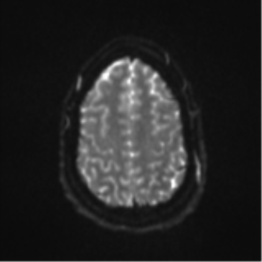 Colloid cyst (Radiopaedia 44510-48181 Axial DWI 24).png