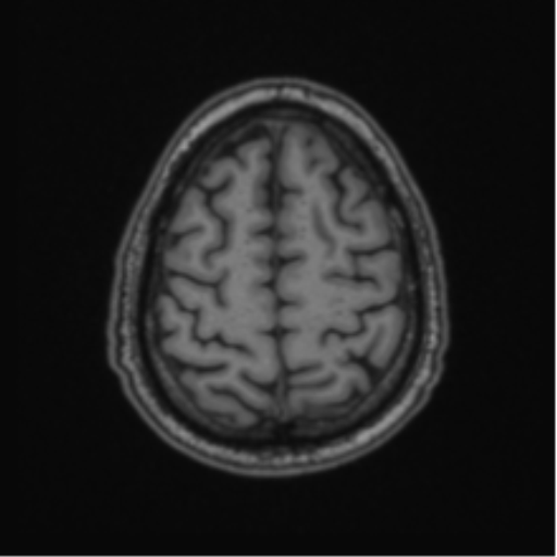 File:Colloid cyst of the third ventricle (Radiopaedia 86571-102662 Axial T1 64).png