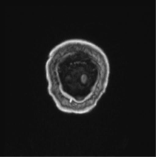 Colloid cyst of the third ventricle (Radiopaedia 86571-102662 Coronal T1 C+ 4).png