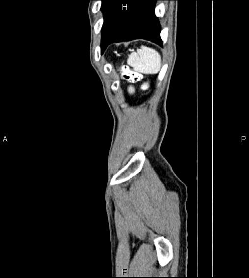 Colon adenocarcinoma - hepatic flexure (Radiopaedia 85635-101395 D 86).jpg