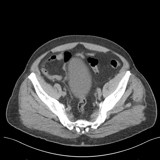 File:Colon adenocarcinoma - splenic flexure (Radiopaedia 34143-35406 Axial Oral contrast 73).png