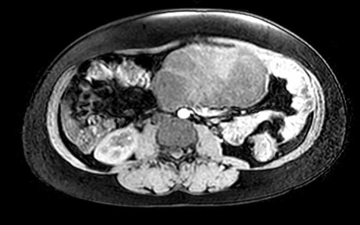 Colon adenocarcinoma with Krukenberg tumors, advanced pregnancy (Radiopaedia 67279-76645 A 44).jpg