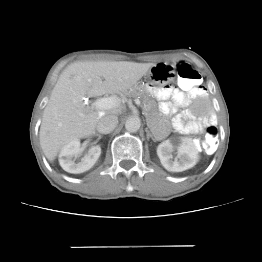 Colon cancer with calcified liver metastasis (Radiopaedia 74423-85307 A 23).jpg