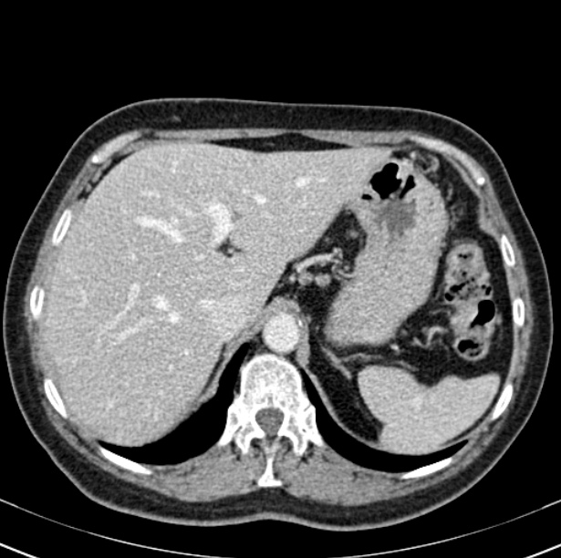 Colon carcinoma with hepatic metastases (Radiopaedia 29477-29961 A 24).jpg