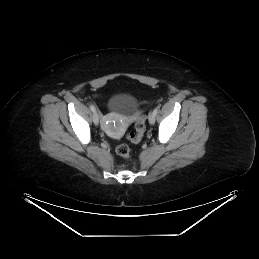 File:Colonic intussusception due to adenocarcinoma (Radiopaedia 86828-102987 A 127).jpg