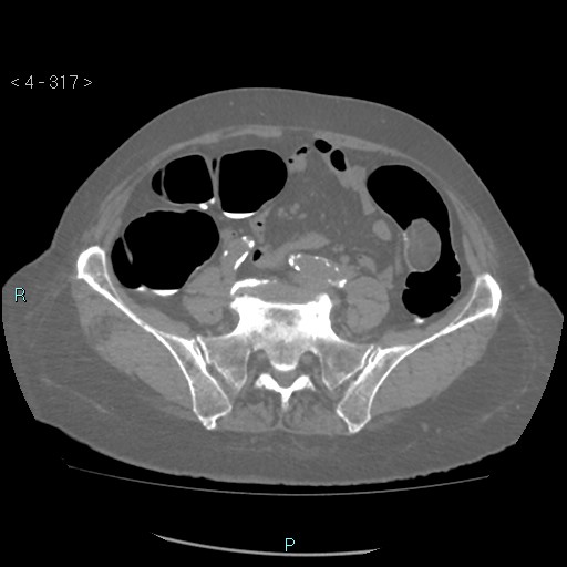 Colonic lipomas (Radiopaedia 49137-54244 Axial bone window 141).jpg