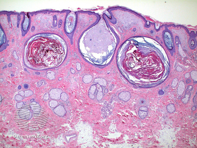 File:Figure 1 (DermNet NZ pathology-t-figure1favrerac).jpg