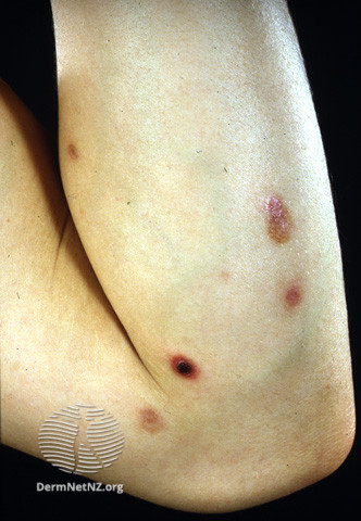 File:Lymphomatoid papulosis (DermNet NZ dermal-infiltrative-lymph-pap2).jpg