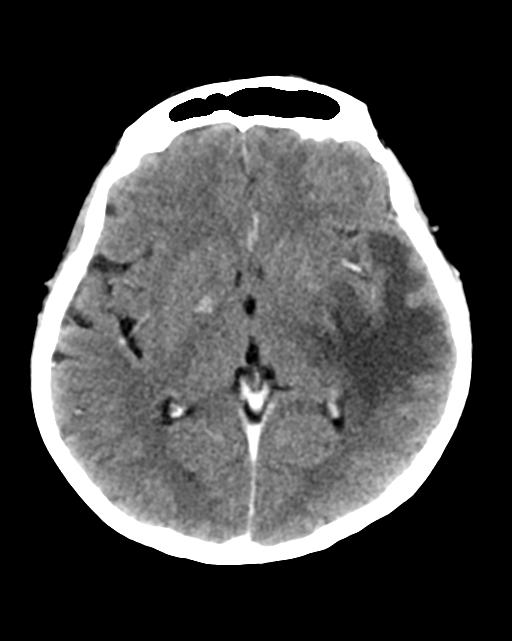 Nasopharyngeal carcinoma with cerebral abscess (Radiopaedia 43018-46275 Axial C+ delayed 26).png