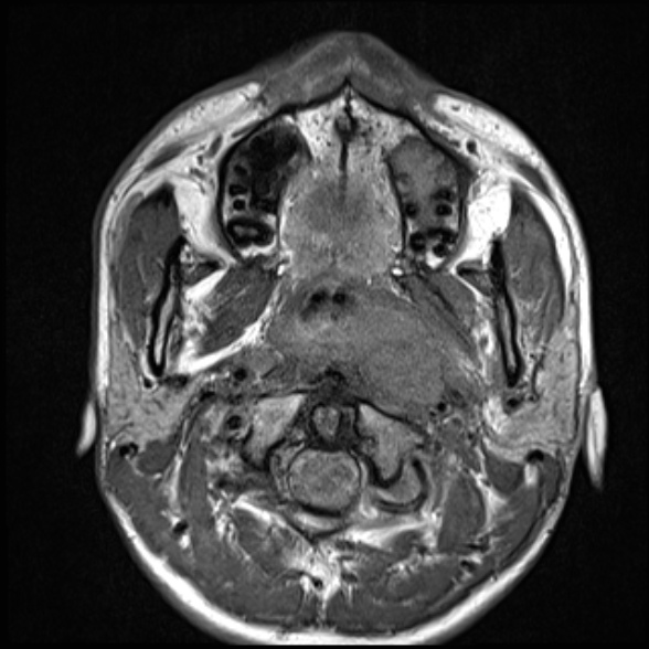 Nasopharyngeal carcinoma with skull base invasion (Radiopaedia 53415-59485 Axial T1 33).jpg