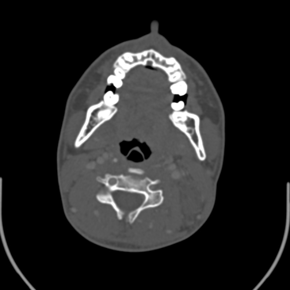 Nasopharyngeal carcinoma with skull base invasion (Radiopaedia 53415-59705 Axial bone window 103).jpg