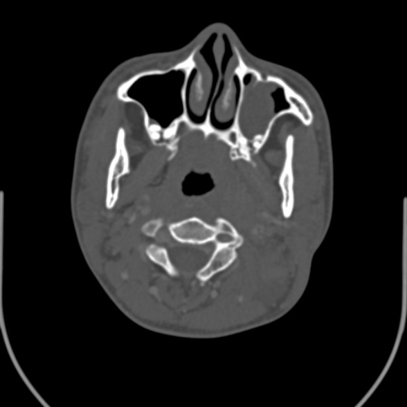 Nasopharyngeal carcinoma with skull base invasion (Radiopaedia 53415-59705 Axial bone window 69).jpg