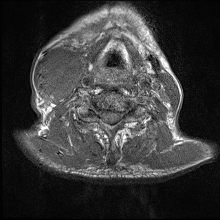 File:Nasopharyngeal carcinoma with skull base invasion (Radiopaedia 59258-66600 Axial T1 8).jpg