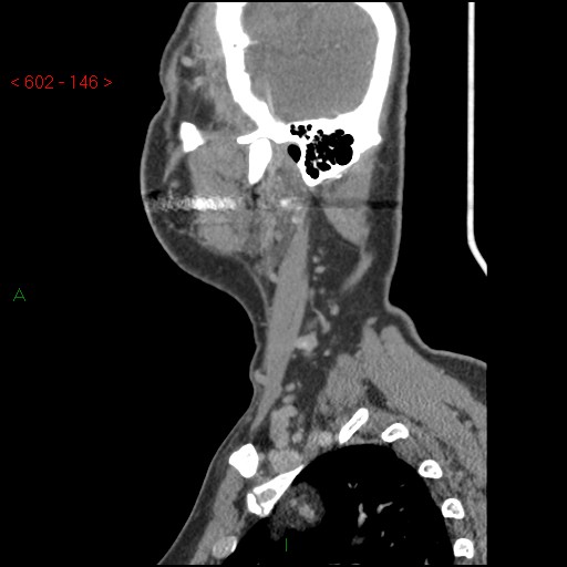 File:Nasopharyngeal lymphoma (Radiopaedia 54235-60433 B 47).jpg