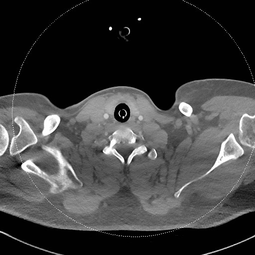 File:Neck CT angiogram (intraosseous vascular access) (Radiopaedia 55481-61945 B 129).jpg