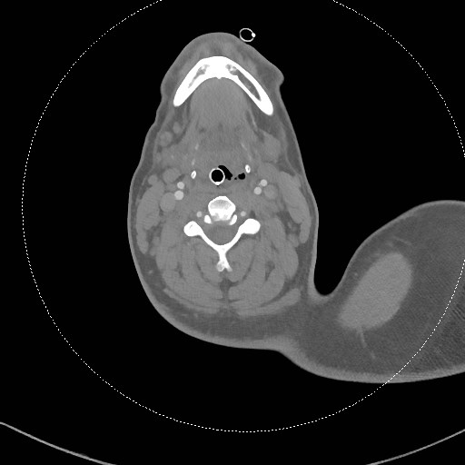 Neck CT angiogram (intraosseous vascular access) (Radiopaedia 55481-61945 B 187).jpg