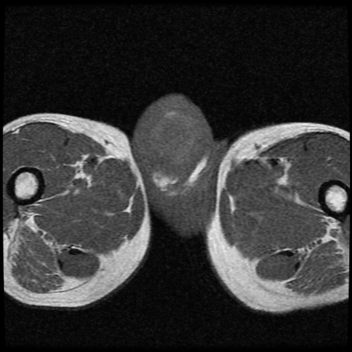 File:Necrotizing epididymo-orchitis with intra-testicular abscess (Radiopaedia 29397-29860 Axial T1 14).jpg