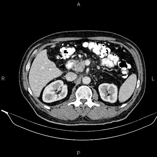 Necrotizing pancreatitis (Radiopaedia 87796-104249 A 21).jpg