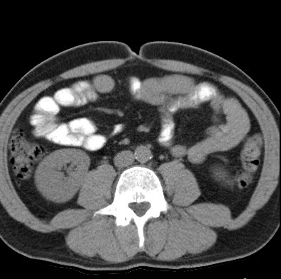 File:Necrotizing pancreatitis with acute necrotic collection (Radiopaedia 14470-14417 Axial non-contrast 30).jpg