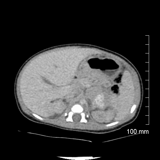 File:Neonatal neuroblastoma (Radiopaedia 56651-63438 Axial non-contrast 28).jpg