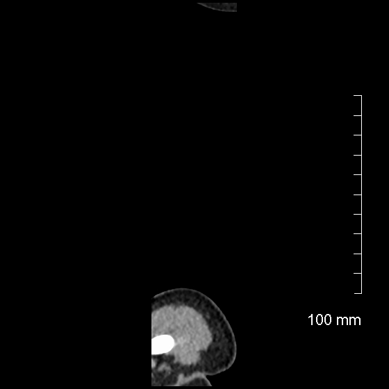 File:Neonatal neuroblastoma (Radiopaedia 56651-63438 C 1).jpg