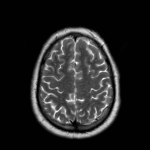 File:Neuro-Behcet's disease (Radiopaedia 21557-21505 Axial T2 18).jpg