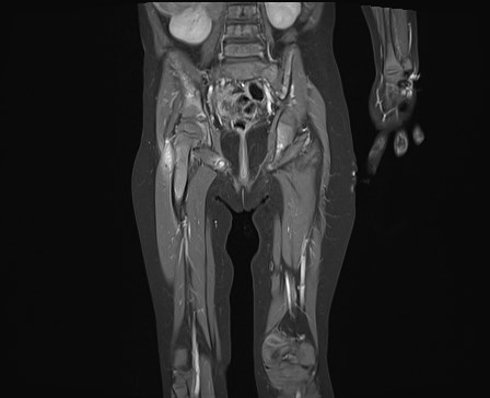 File:Neuroblastoma with bone metastases (Radiopaedia 67080-76414 E 15).jpg