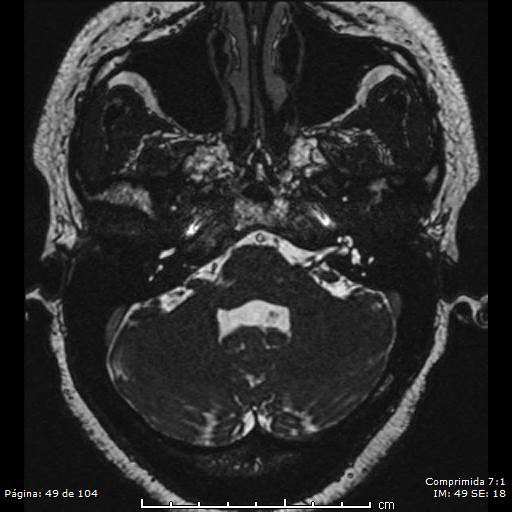 Neurocysticercosis (Radiopaedia 58636-65832 I 49).jpg