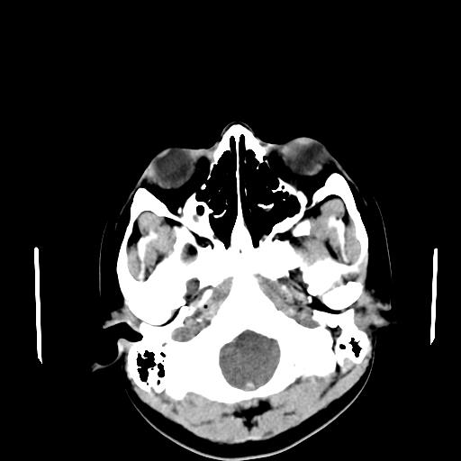 File:Neurofibromatosis type 2 (Radiopaedia 25389-25637 Axial non-contrast 2).jpg
