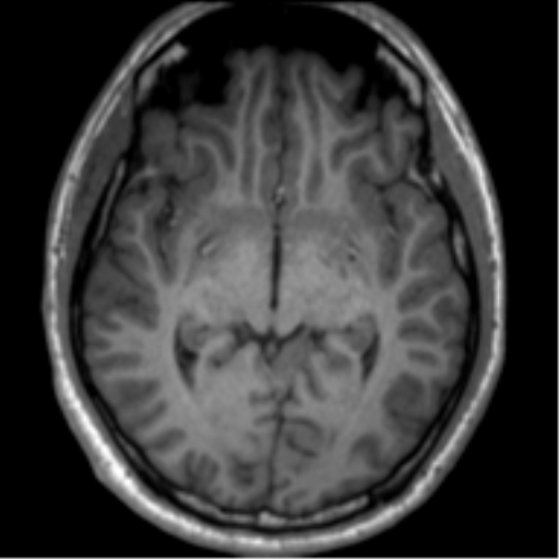 File:Neurofibromatosis type 2 (Radiopaedia 44936-48838 Axial T1 64).png