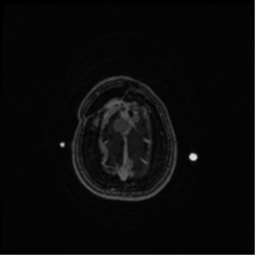 Neurofibromatosis type 2 (Radiopaedia 45229-49244 Axial T1 C+ 105).png