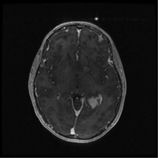 Neurofibromatosis type 2 (Radiopaedia 45229-49244 Axial T1 C+ 61).png