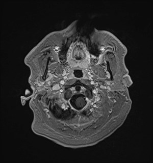 Neurofibromatosis type 2 (Radiopaedia 79097-92049 Axial T1 C+ 26).jpg