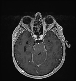 Neurofibromatosis type 2 (Radiopaedia 79097-92049 Axial T1 C+ 78).jpg